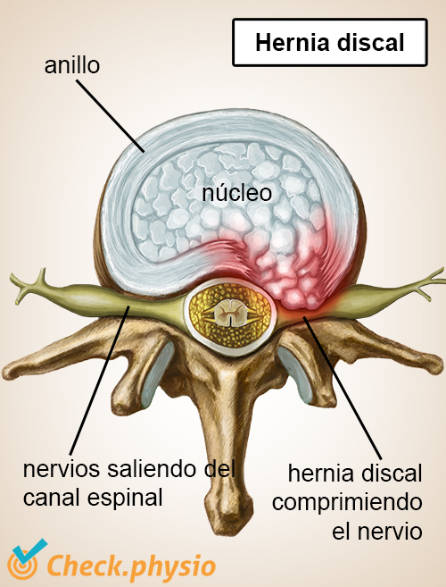 afbeelding_alt_wervelkolom-wervel-tussenwervelschijf-hernia-zenuwen